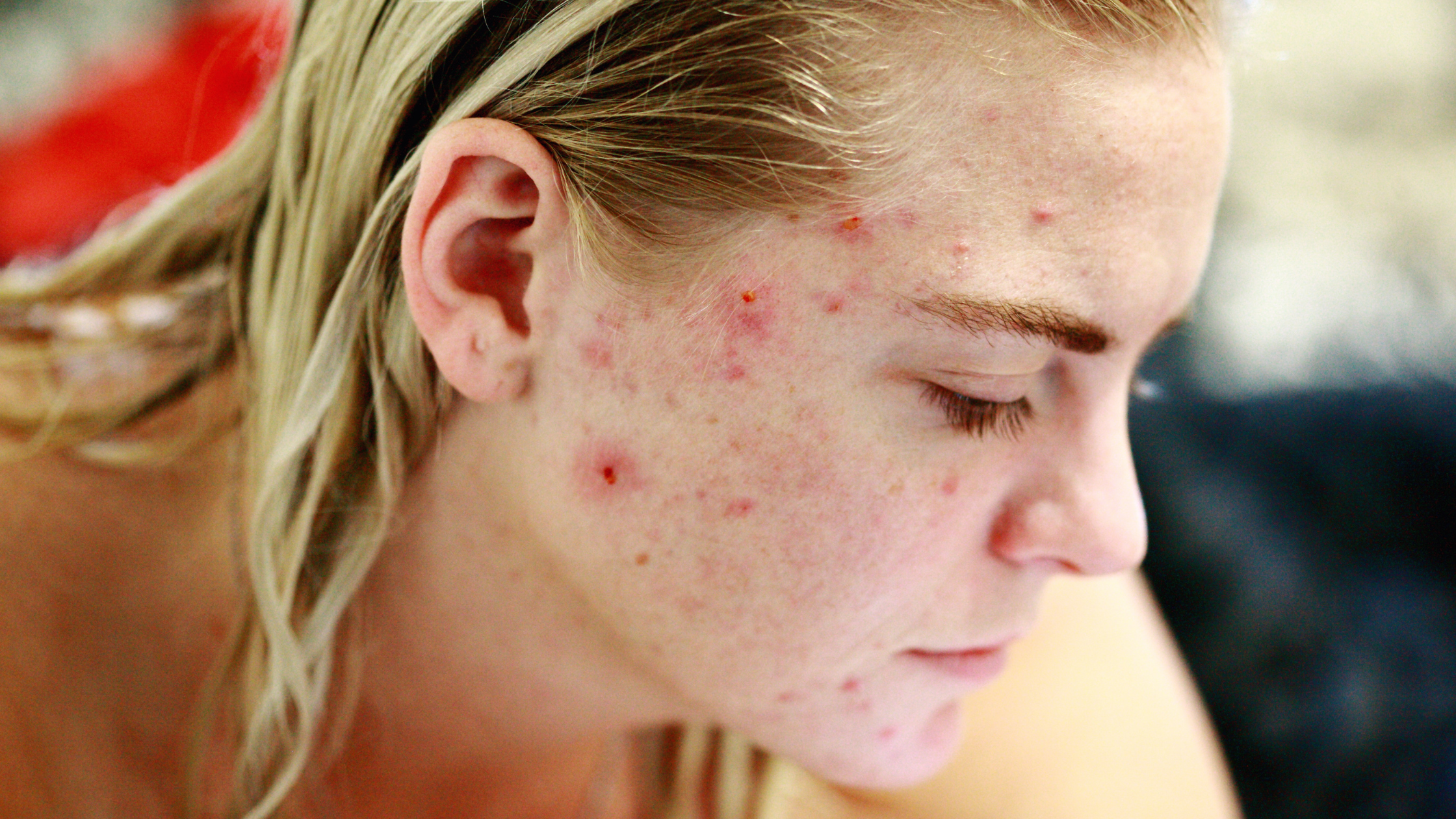 Millennial woman with visible hormonal breakout on her cheek